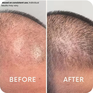 Side-by-side comparison of scalp before and after treatment.