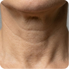 A close-up of a person's neck showing horizontal lines and wrinkles in the skin.