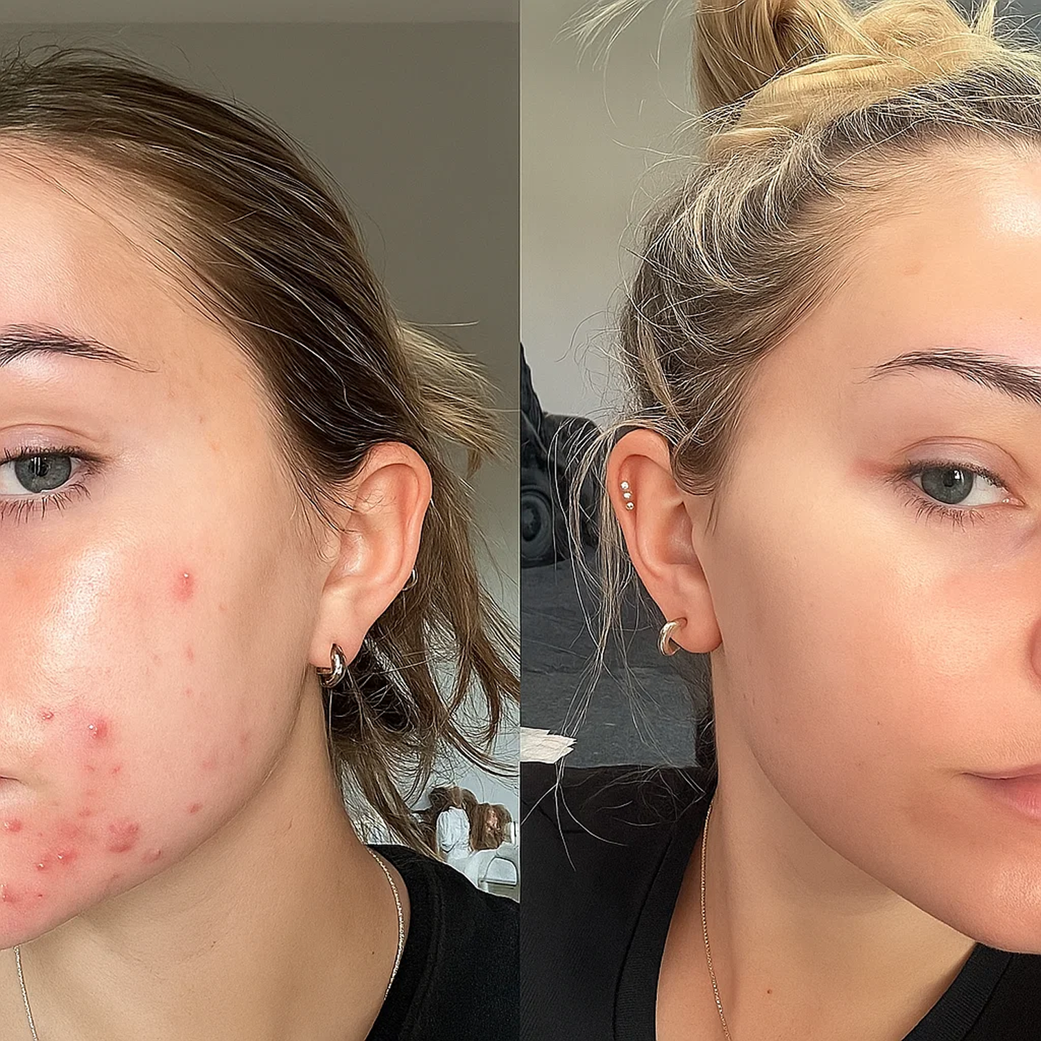 Side-by-side before and after image showing skincare results on two faces.