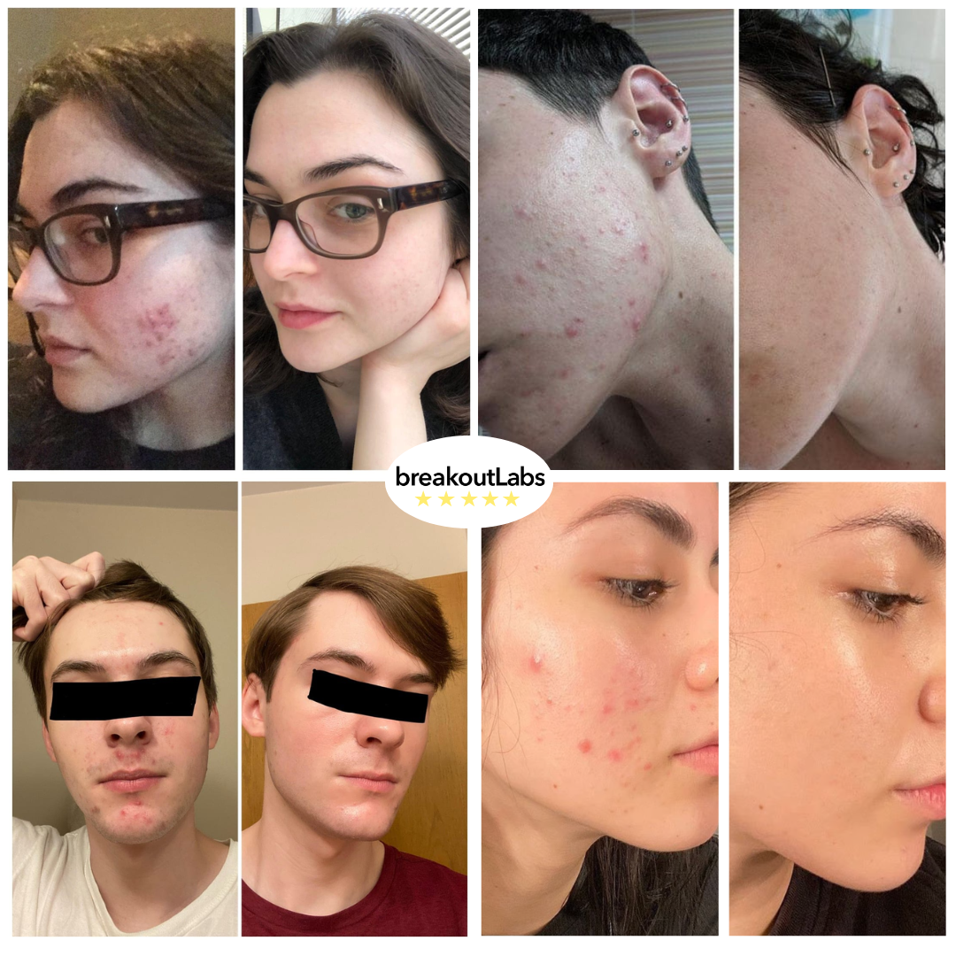 A collage of four before-and-after photo sets showing improvements in facial acne.
