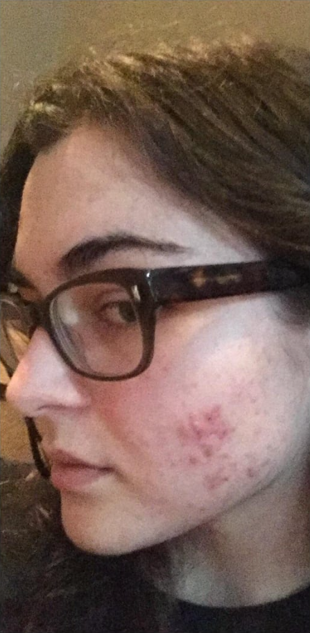 A close-up profile of a person wearing glasses, with acne visible on their cheek.