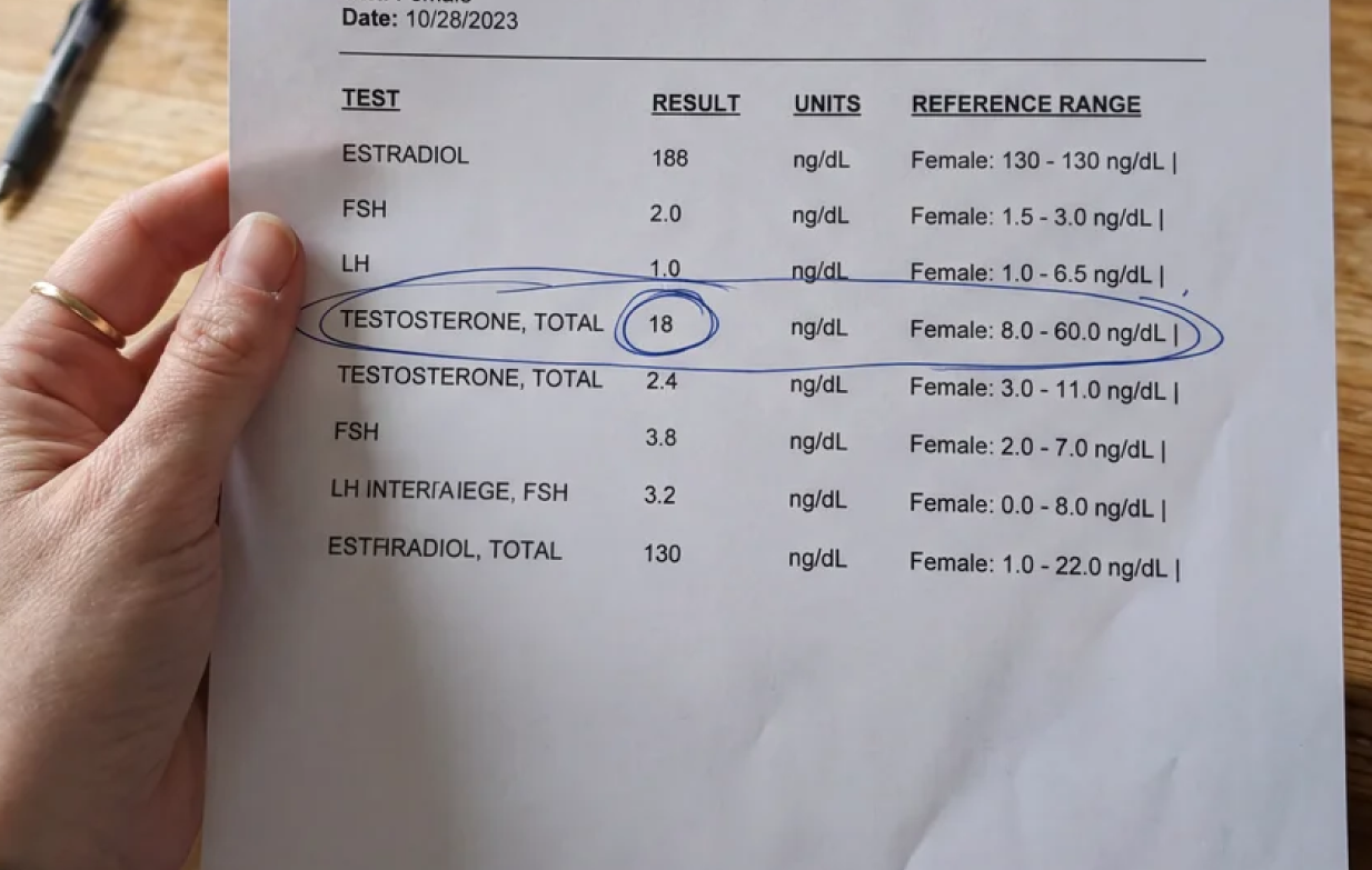 A person holds a lab report showing hormone levels, with the 'Testosterone, Total' result circled in blue ink.