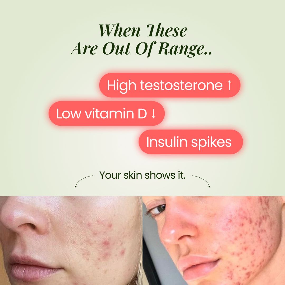 Before and after images showing acne improvement on a forehead.