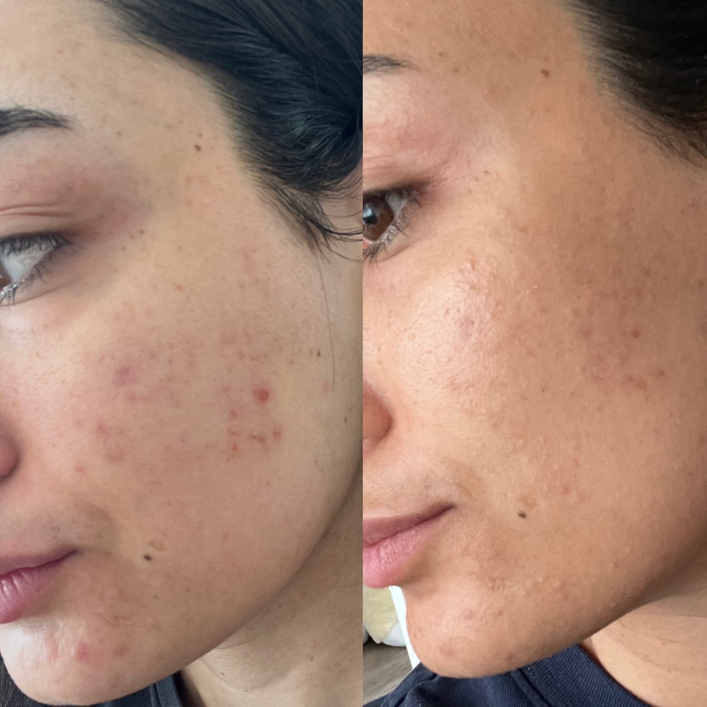 Side-by-side comparison of facial skin with acne before and clearer skin after.