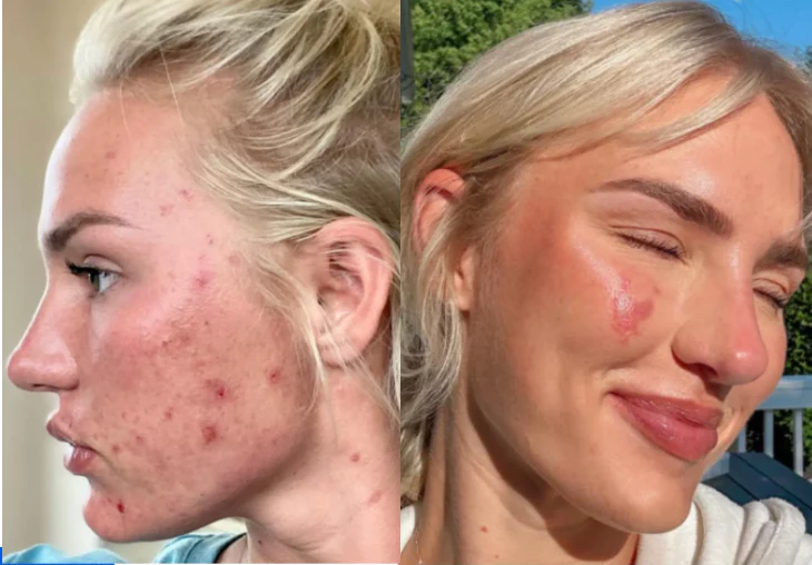 Side-by-side images showing a woman's skin before and after acne treatment.