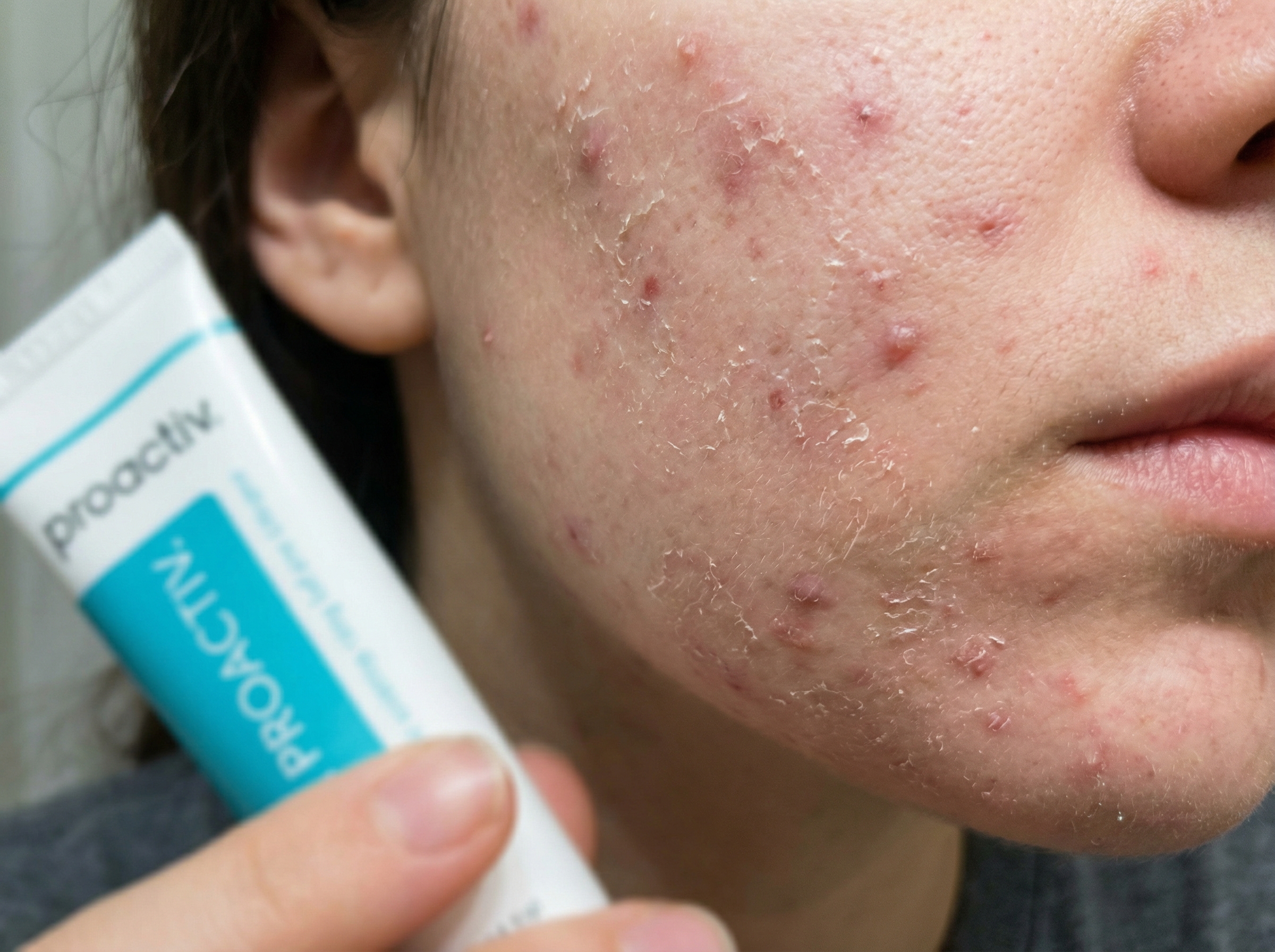 A close-up of a person's cheek with acne and peeling skin, holding a tube of Proactiv.