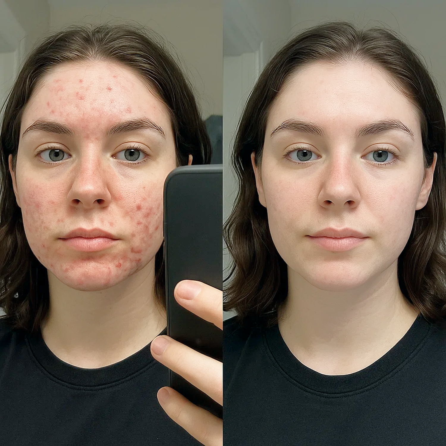 Side-by-side image comparison of a woman's face with acne and clear skin.