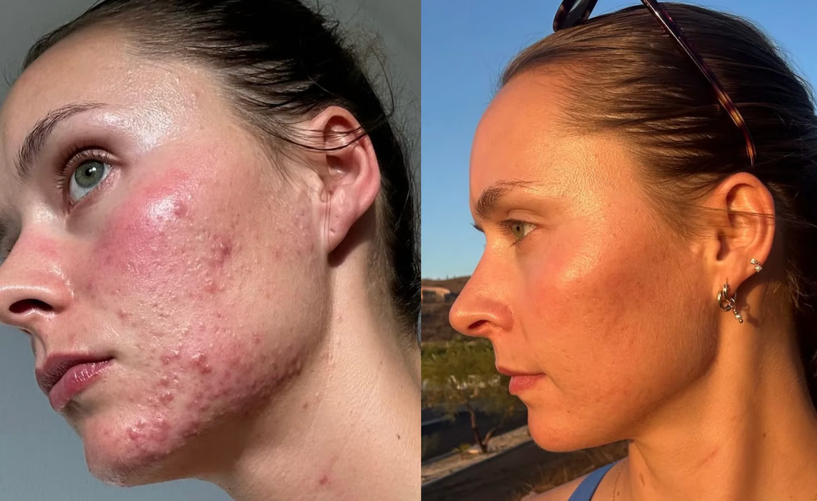 A side-by-side comparison showing a woman's face with acne on the left and clearer skin on the right.