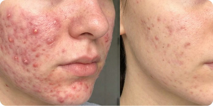 A before and after comparison of a person's cheek, showing severe acne on the left and clearer skin on the right.