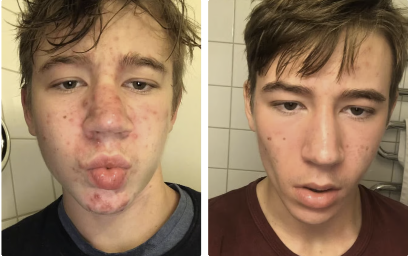 A before-and-after comparison showing a young man's face with severe acne and then with clearer skin.