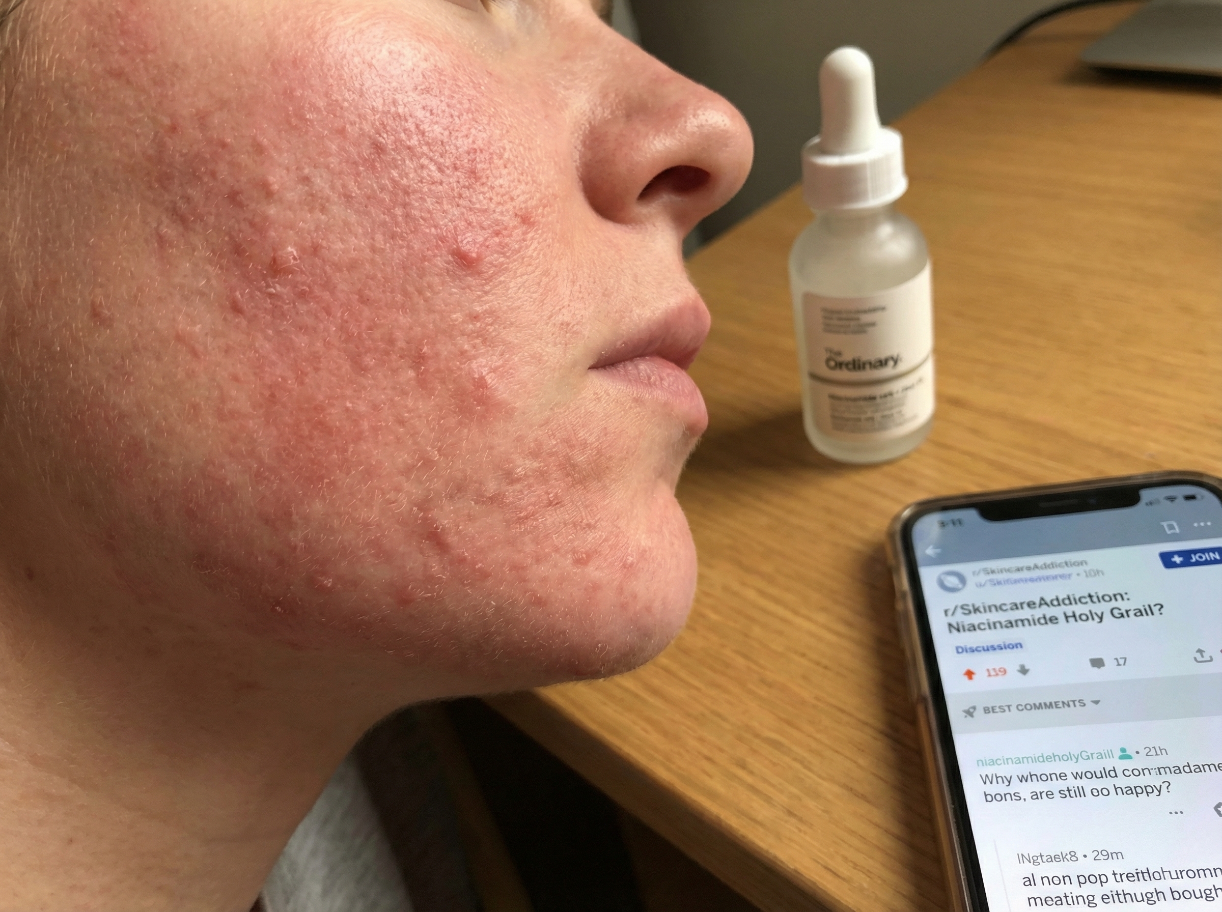 A close-up of a person's face with red, bumpy skin, next to a skincare bottle and a smartphone.