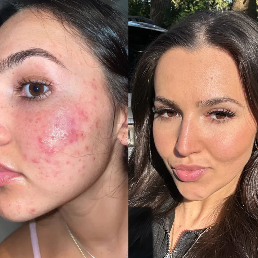 Side-by-side comparison of a woman's face showing acne and clear skin.