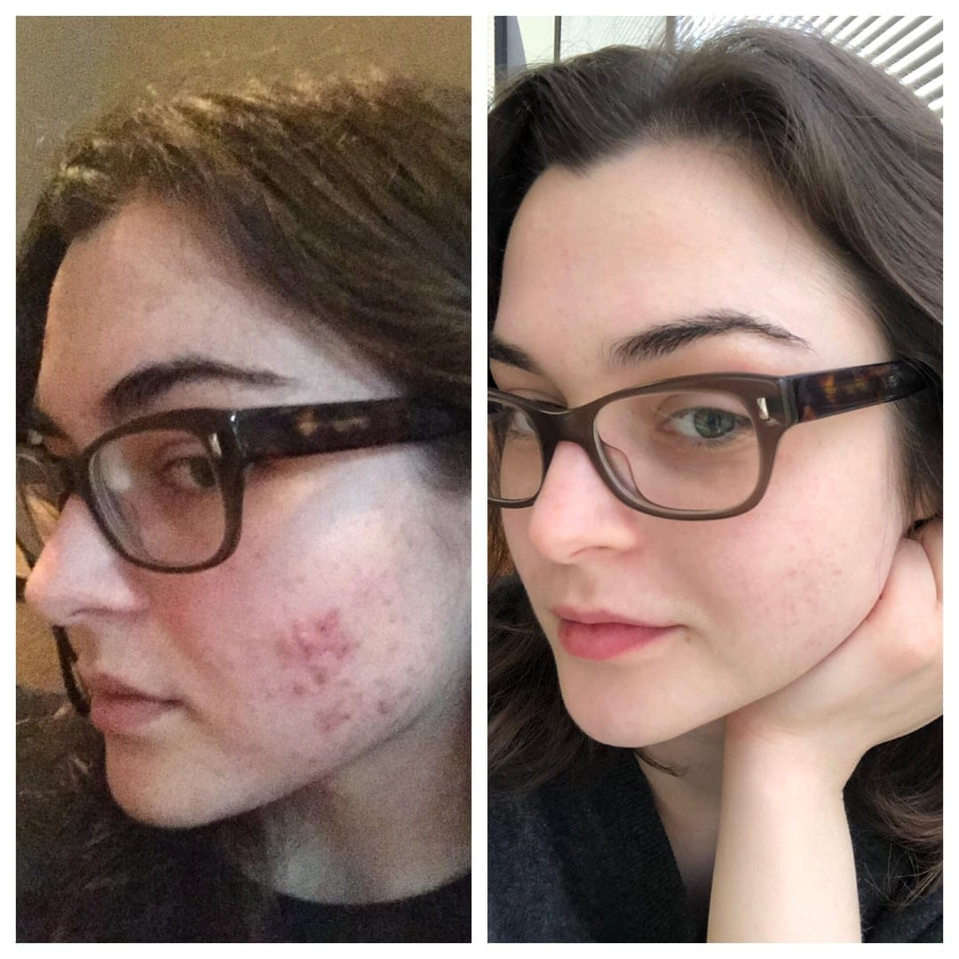 A before-and-after split image showing a woman's face with a significant reduction in acne.