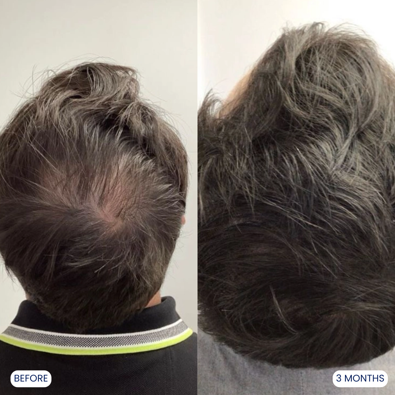 Comparison of hair growth before and after three months.