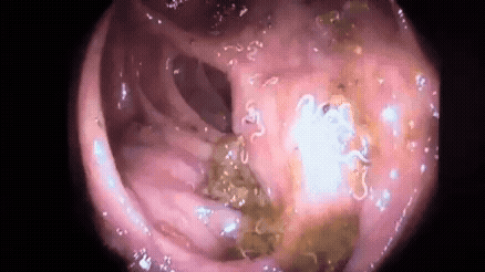 Parasites living inside the human body