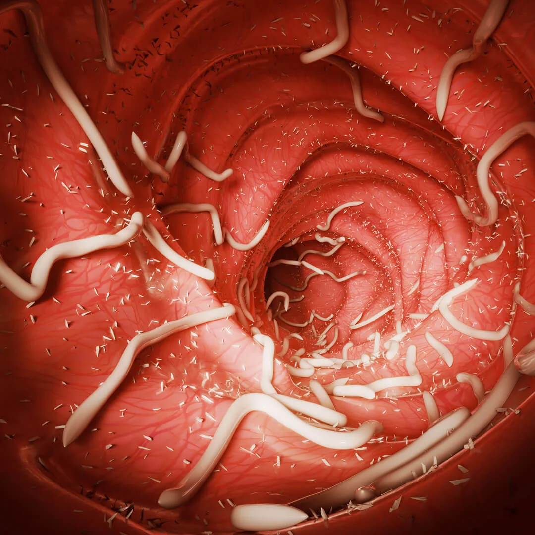 A medical illustration showing the inside of an intestine infested with numerous white parasitic worms.