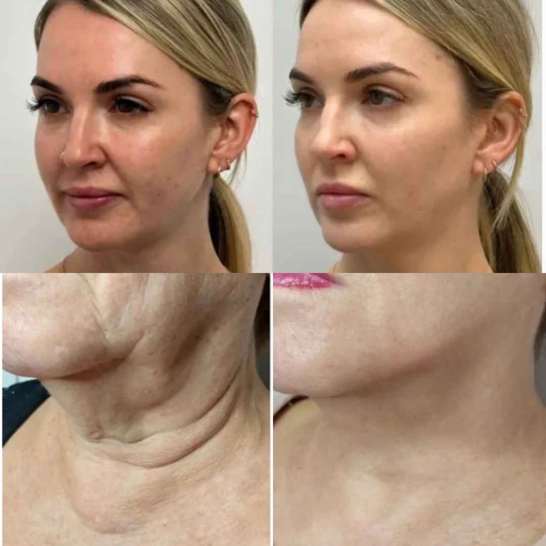Before and after comparison of a woman's face and neck.