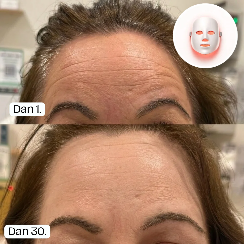 A before-and-after image showing a reduction in a woman's forehead wrinkles from day 1 to day 30.