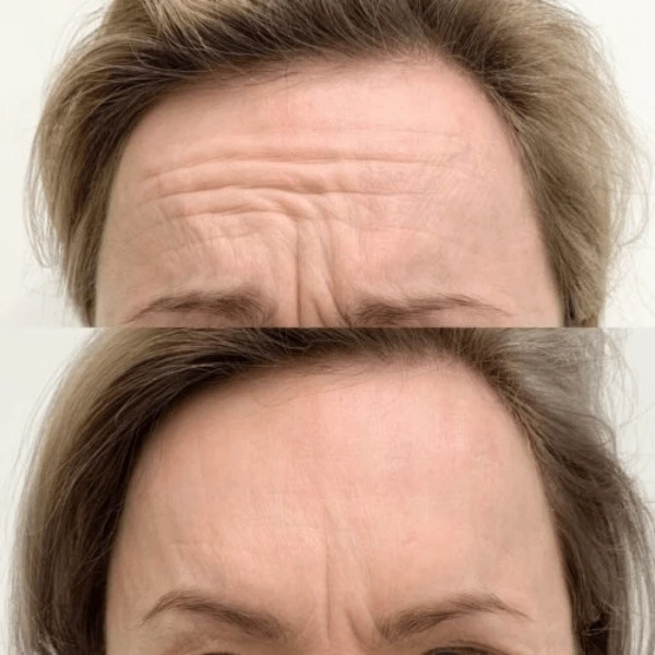 A before and after image showing a woman's forehead with wrinkles reduced.