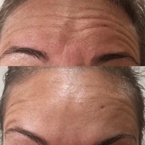 A before and after image showing the reduction of wrinkles on a person's forehead.