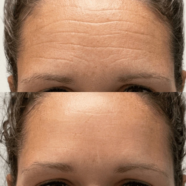 A before and after image showing the reduction of deep horizontal wrinkles on a woman's forehead.
