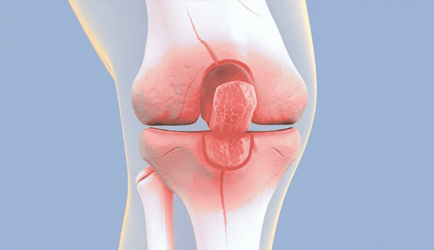 Illustration of a human knee joint with highlighted red areas.