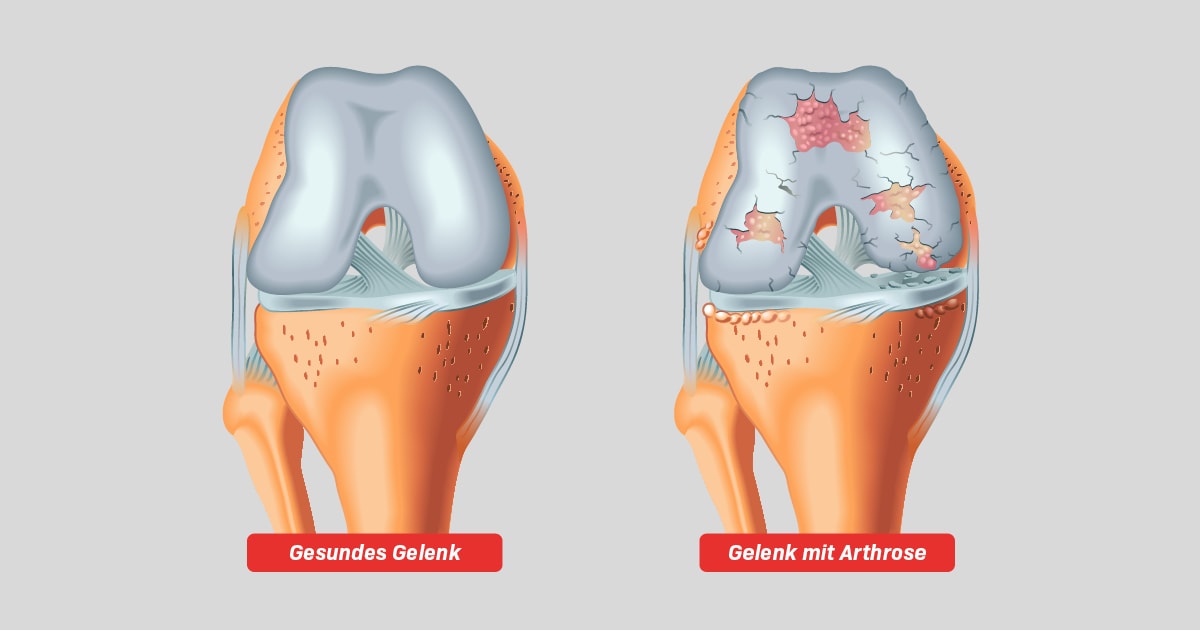 Illustration comparing healthy joint and joint with arthritis.