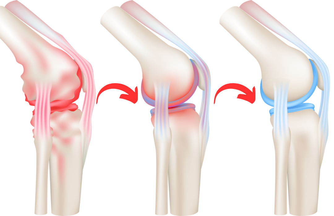 Illustration of knee joint inflammation and treatment progression in three stages.
