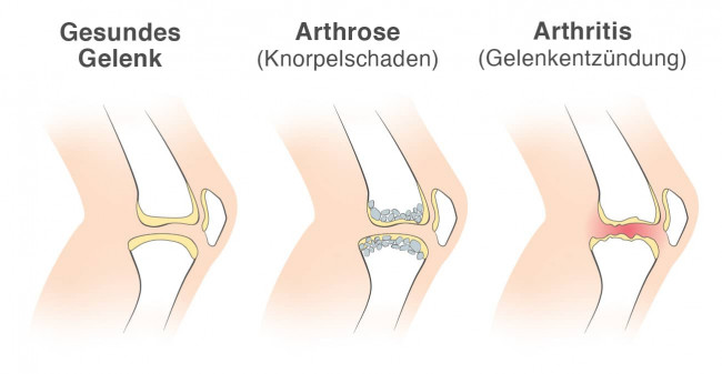 Illustration comparing healthy joint, arthrosis, and arthritis in German.