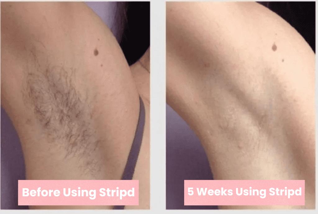 Two images showing hair removal progress under the arm labeled before and after using Stripd.