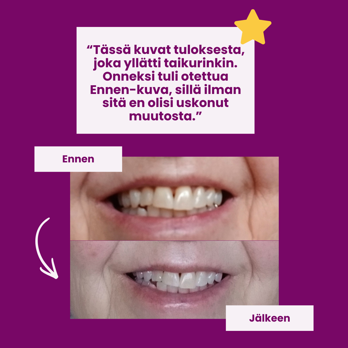 Before and after photos of a person's smile, showing teeth that are straighter in the after photo.
