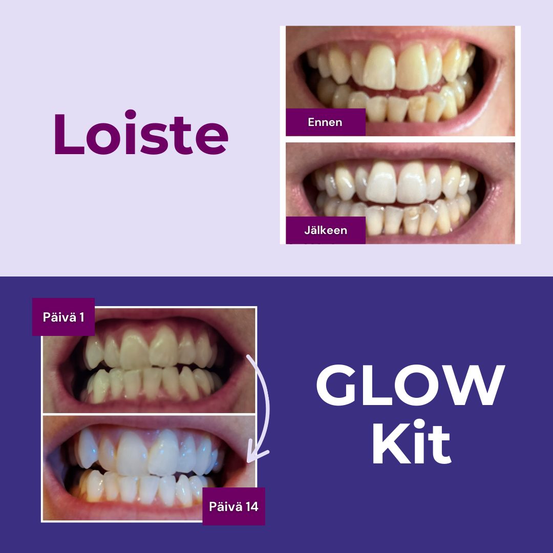 Before and after photos showing the results of a teeth whitening kit, with teeth appearing visibly whiter.