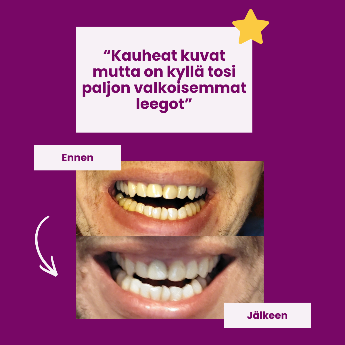 A before and after comparison of teeth whitening, showing yellowish teeth becoming significantly whiter.
