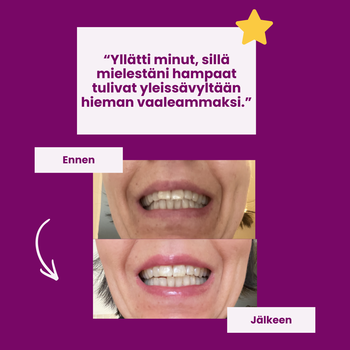 Before and after photos showing the results of a teeth whitening treatment, with a customer testimonial in Finnish.