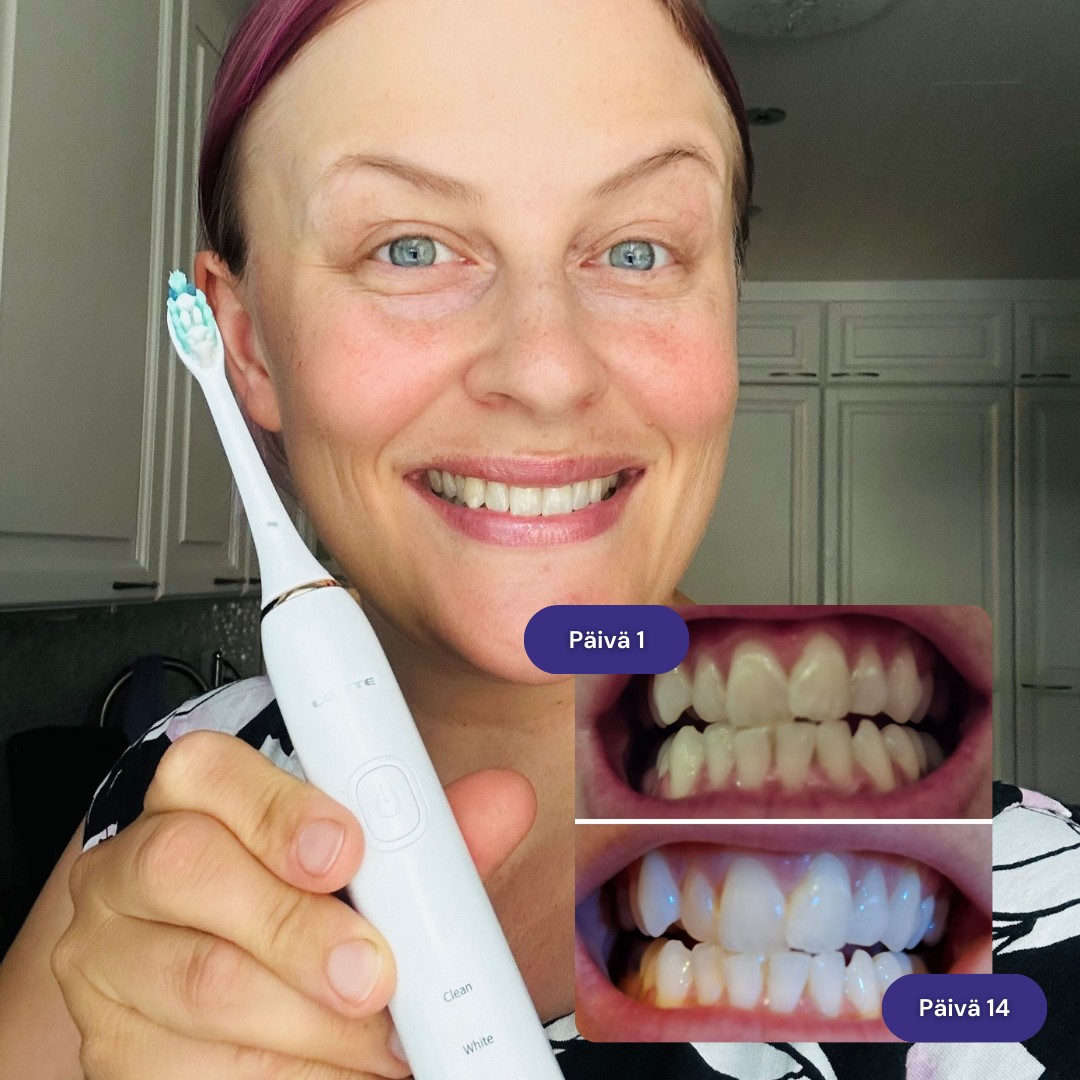 Person smiling with an electric toothbrush, before and after teeth whitening images shown.