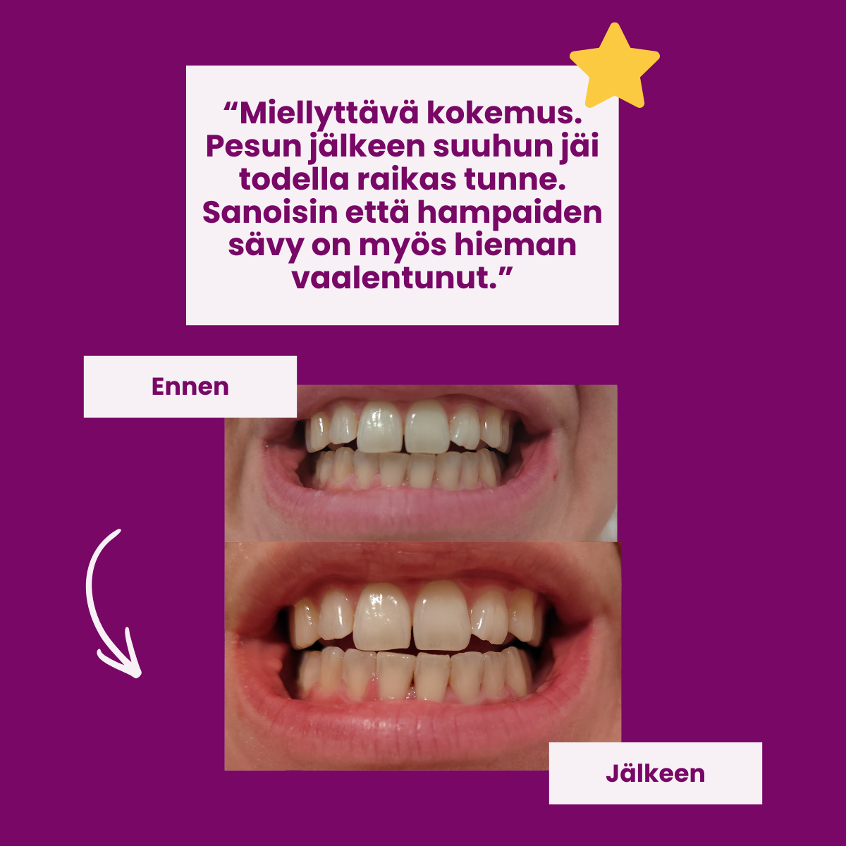 A before and after comparison of teeth, showing the whitening results, next to a customer testimonial in Finnish.