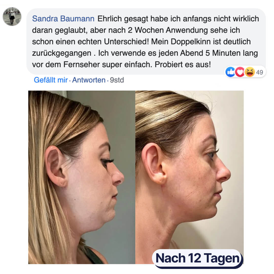 Side-by-side comparison of a woman's face before and after 12 days.