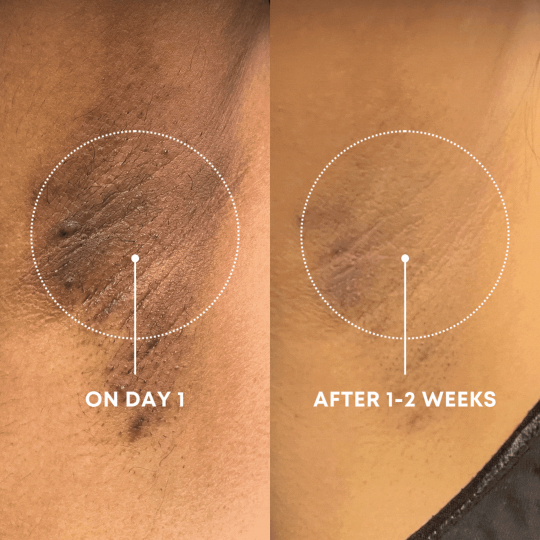 Comparison of skin texture on Day 1 and after 1-2 weeks.