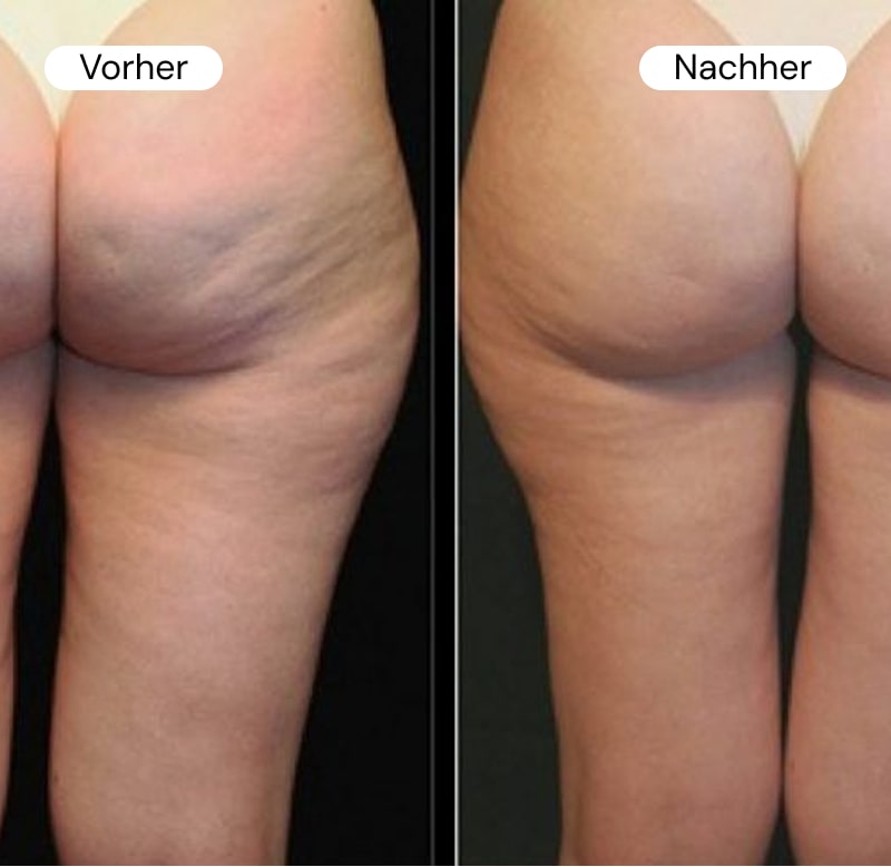 Before and after comparison of skin texture on thighs.