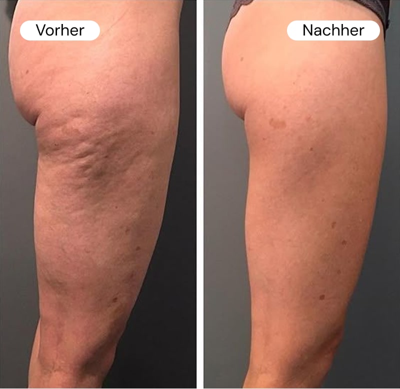 Side-by-side comparison of a leg before and after treatment.