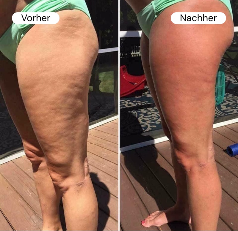 Side-by-side comparison of a woman's thighs labeled 'Vorher' and 'Nachher.'