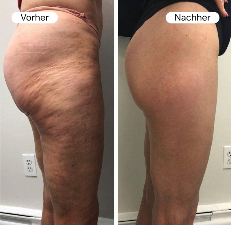Side-by-side comparison of a person's thigh before and after treatment.
