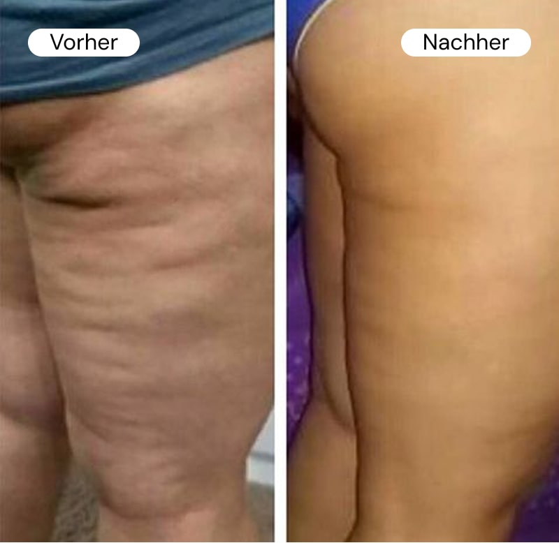 Side-by-side comparison of legs with and without cellulite.