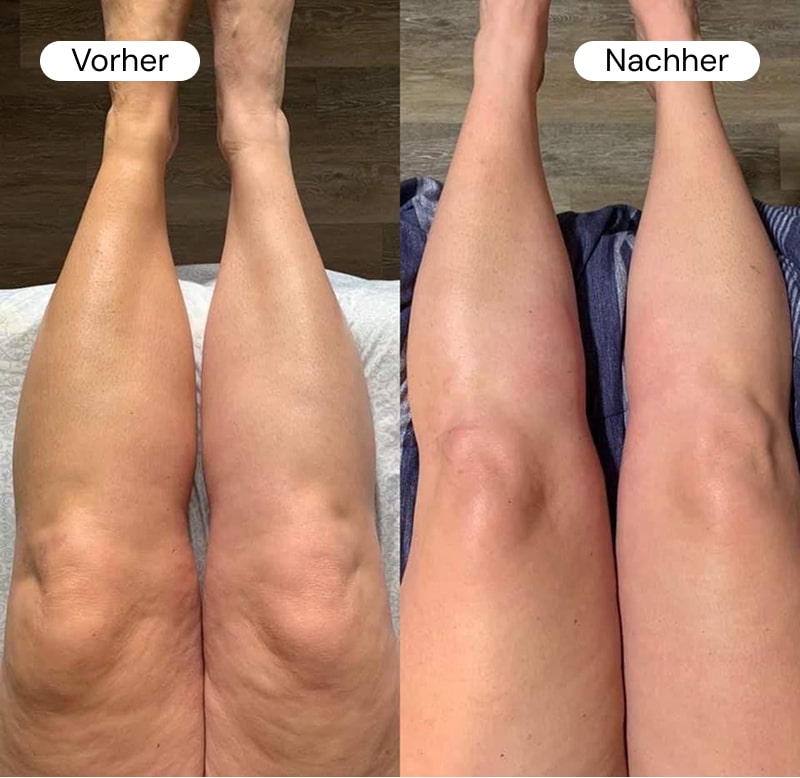 Side-by-side comparison of legs labeled 'Vorher' and 'Nachher'.