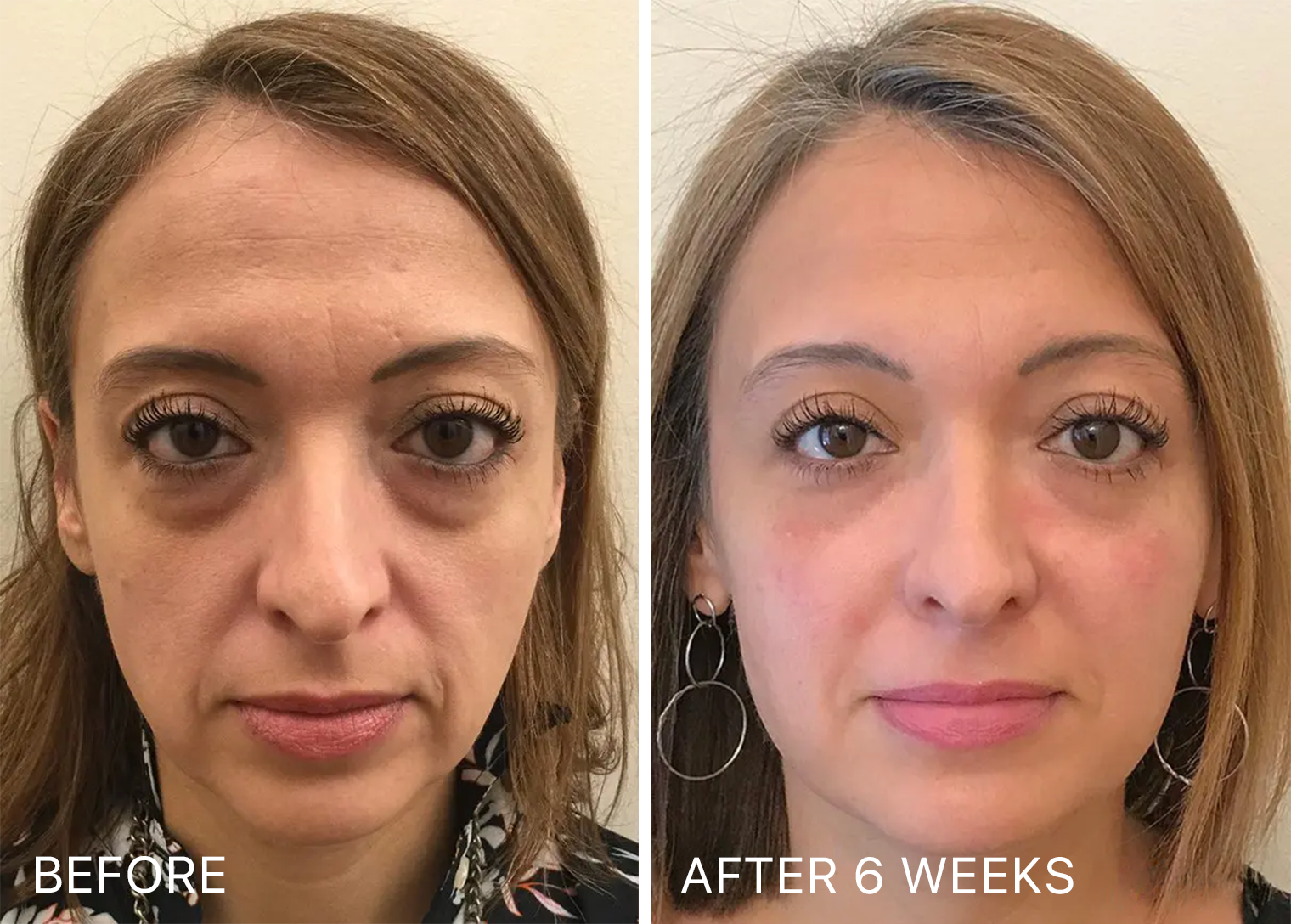 Side-by-side comparison of a woman's face labeled 'Before' and 'After'.