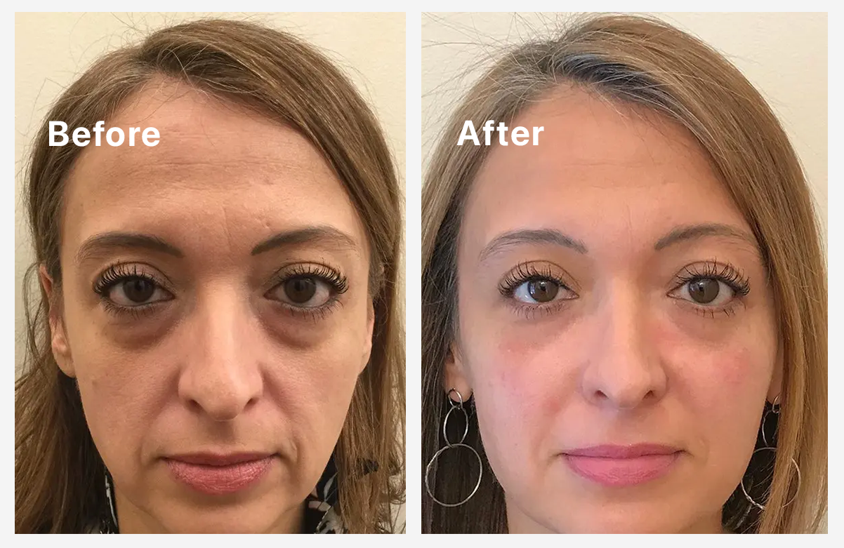Side-by-side comparison of a woman's face labeled 'Before' and 'After'.