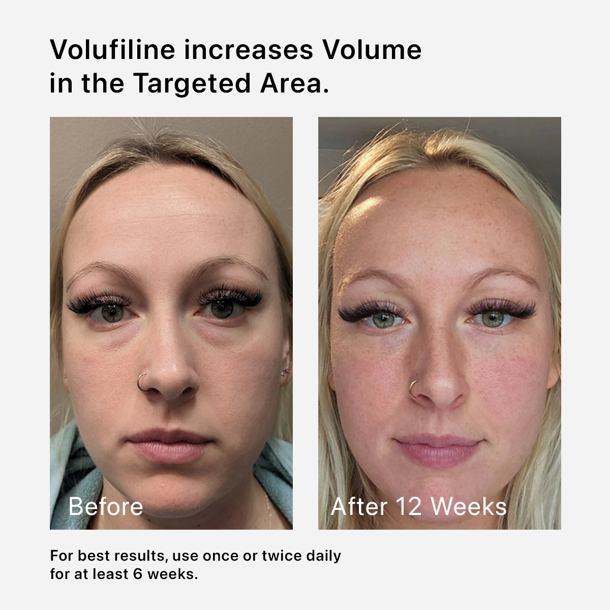 Side-by-side comparison of a woman's face before and after 12 weeks.
