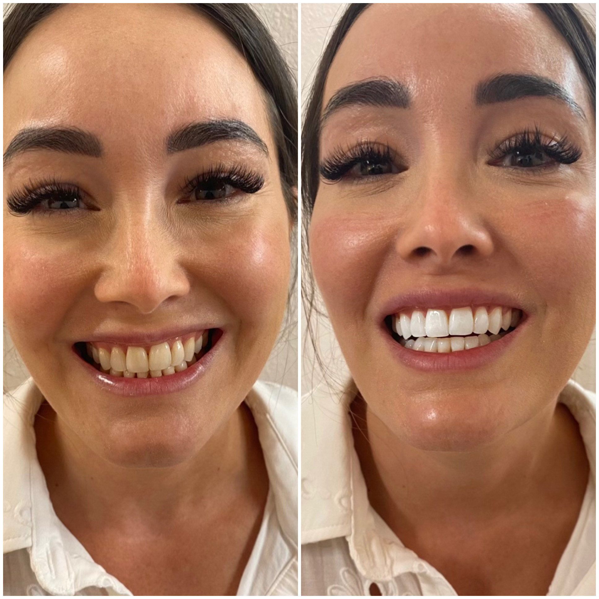 Side-by-side comparison of a woman's smile before and after dental treatment.
