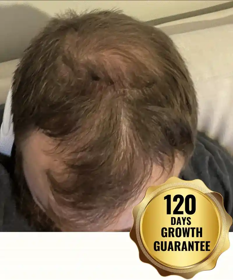 Top view of a man's head with thinning hair and a growth guarantee badge.