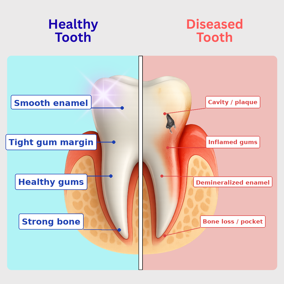 Diagram comparing healthy and diseased tooth with labels for enamel, gums, and bone.